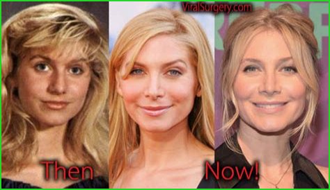 Elizabeth Mitchell Plastic Surgery Before and After